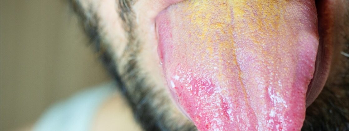 Žlutý jazyk